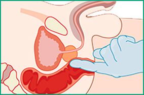 Masaje de próstata - tratamiento para la prostatitis