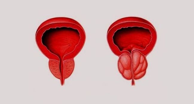 Próstata sana (izquierda) e inflamada por prostatitis (derecha)