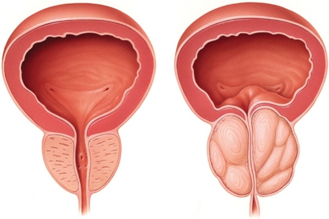 Próstata normal (izquierda) y con signos de inflamación en prostatitis (derecha)