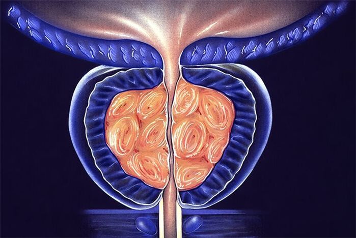 inflamación de la próstata en los hombres