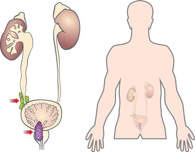 síntomas y causas del adenoma de próstata