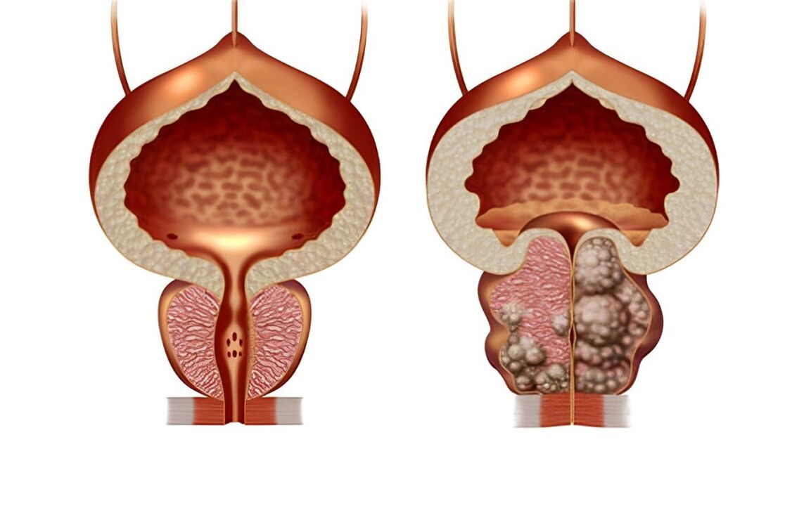 ¿Cómo se ve el adenoma de próstata 