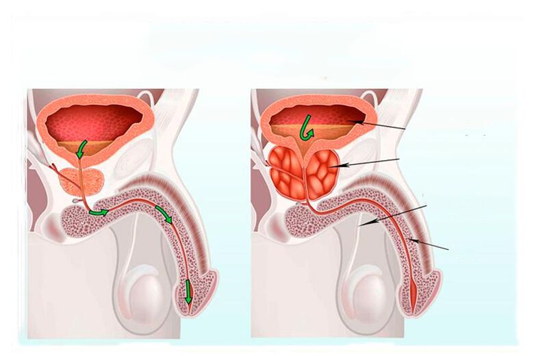 norma e inflamación de la glándula prostática