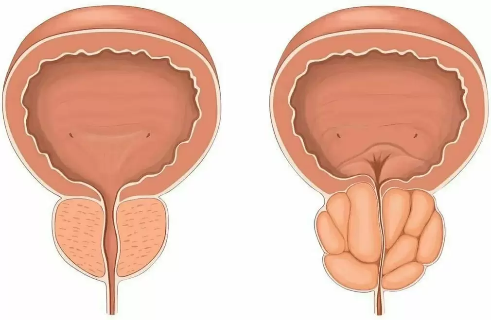 Próstata normal y dolor de próstata