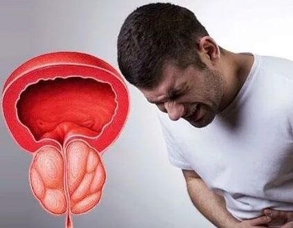 Síntomas de prostatitis crónica en hombres