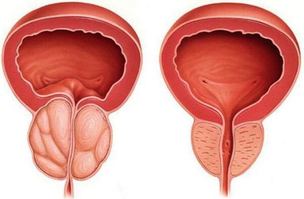 próstata sana e inflamada con prostatitis